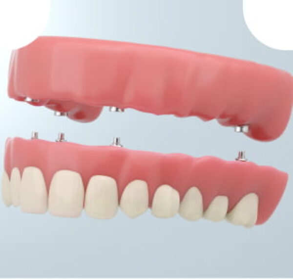  Dental Implant Rowtree Dental Care
